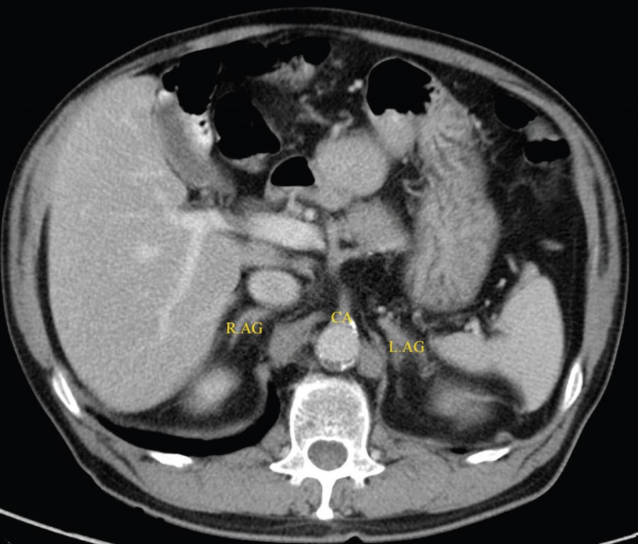 Comparison Study Of Two Methods Of Identifying The Adrenal Glands On