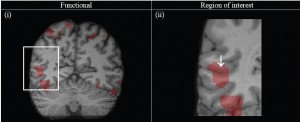 Figure 4: In vivo structural MR and fMR results from subject 2 (left hemisphere). (i) Coronally oriented slice through high-resolution MR image with overlaid functional activation map. The region of interest has been highlighted (white box). (ii) Enlarged view of the highlighted area in (i) showing co-localisation of functional activation and putative anatomically defined V5/MT identified in Experiment 1 (white arrow).